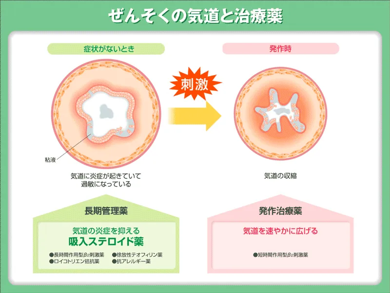 ぜんそくの気道と治療薬